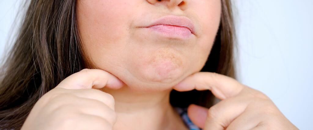 Chin Up! A Complete Guide to Chin Ptosis