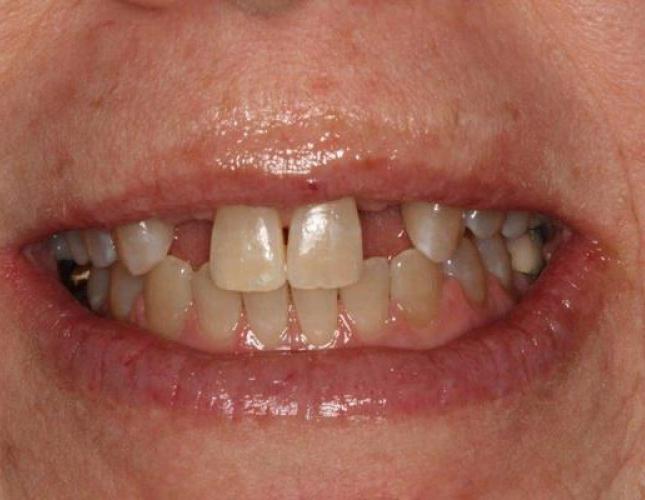 Ortho before