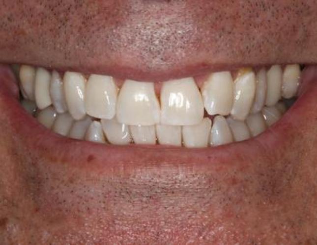 ZOOM! Whitening after