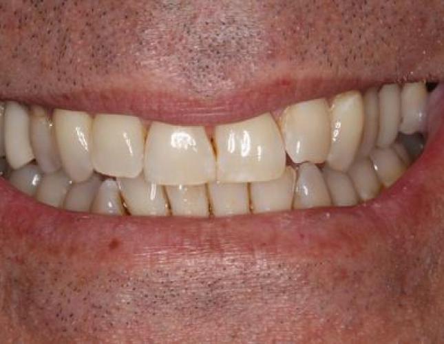 ZOOM! Whitening before