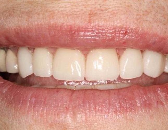 Cosmetic Bonding 1 after