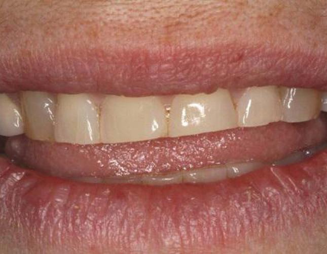 Cosmetic Bonding 1 before