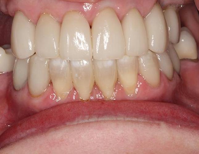 Cosmetic Bonding 2 after
