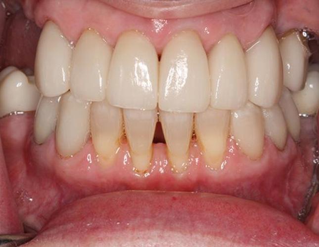 Cosmetic Bonding 2 before