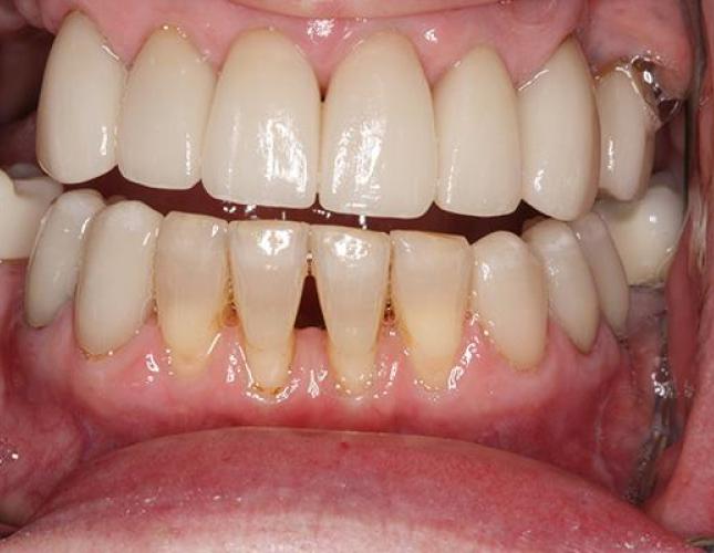 Cosmetic Bonding 3 before