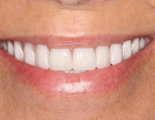 Dentures after