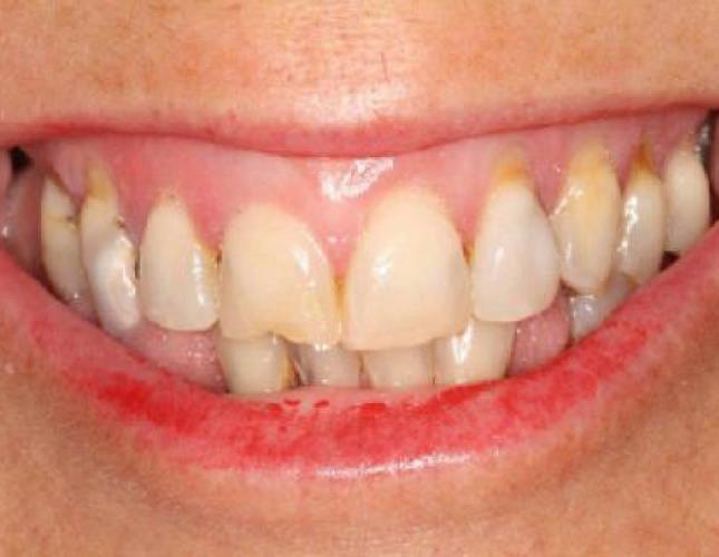 Dentures before