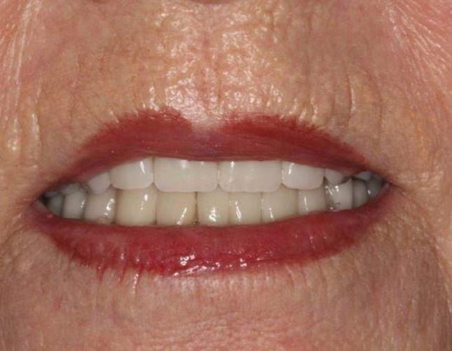 Dentures after