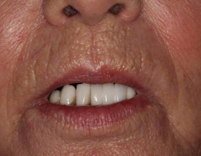 Dentures before