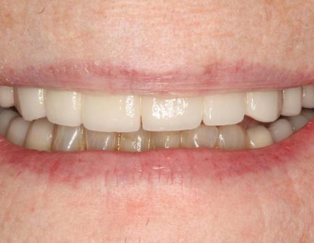 Implant Supported Bridge after