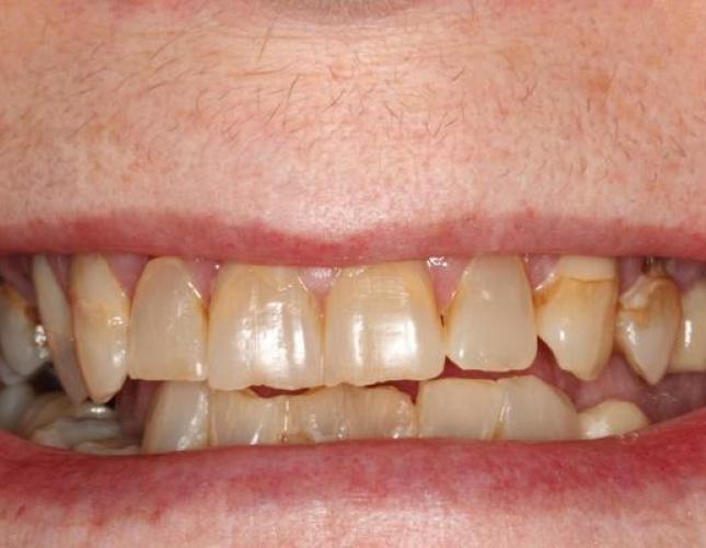 Implant Supported Bridge before