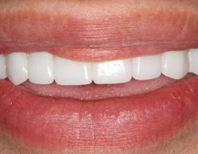Implant Supported Dentures 1 after