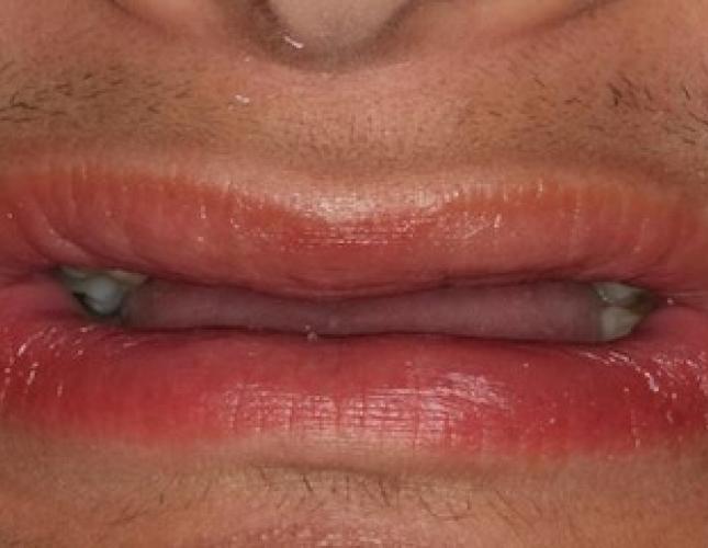 Implant Supported Dentures 1 before