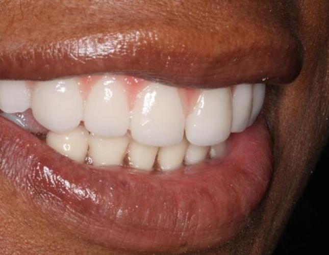 Implant Supported Dentures 2 after