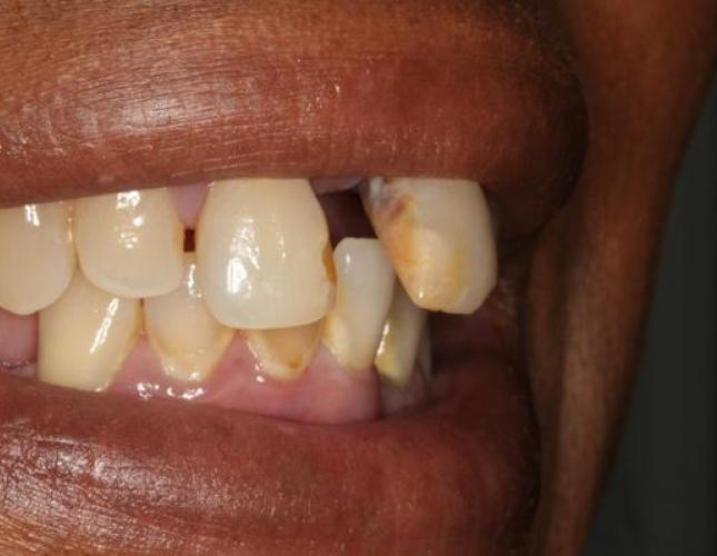 Implant Supported Dentures 2 before