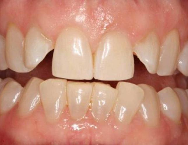 Invisalign 1 before