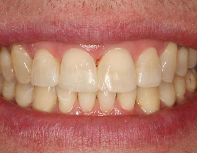 Invisalign 2 after