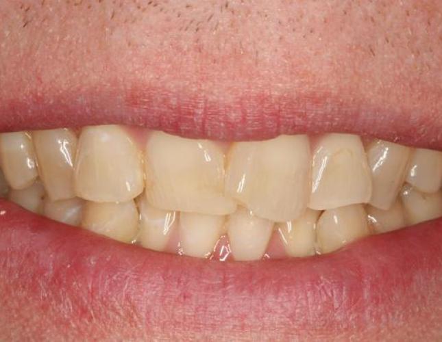 Invisalign 2 before