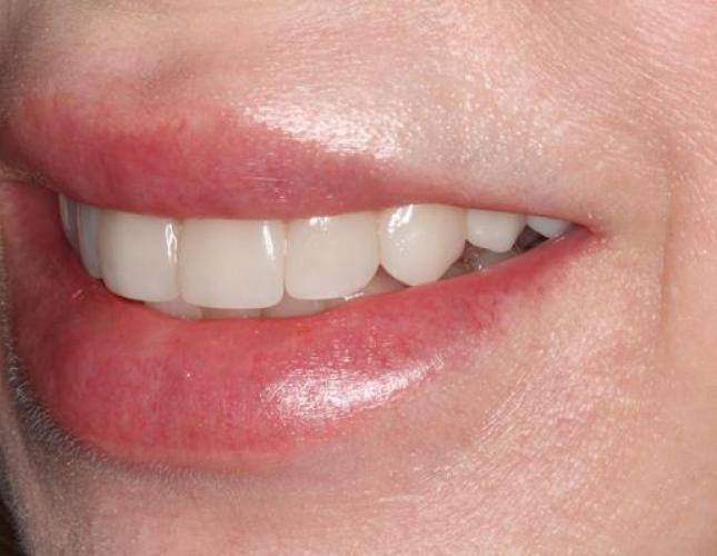 Veneers 1 after
