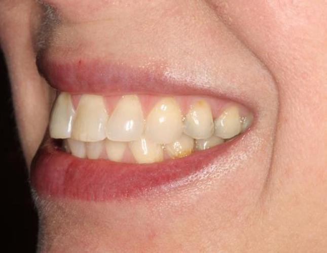 Veneers 1 before