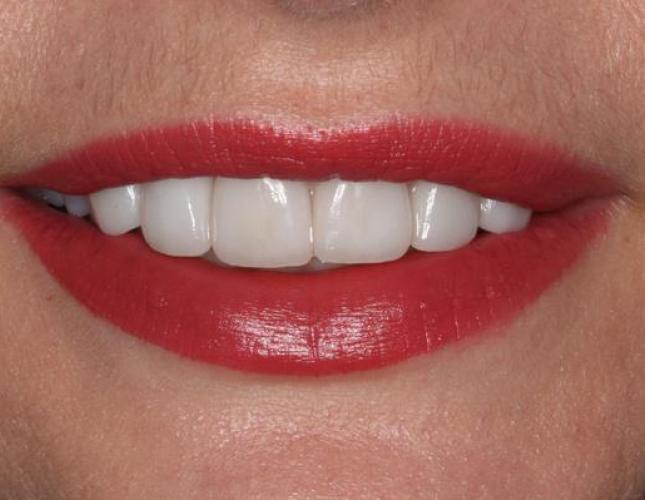 Veneers 2 after