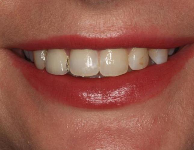 Veneers 2 before