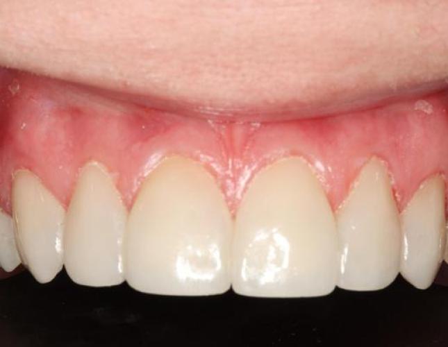 Veneers 3 after
