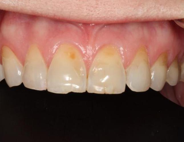 Veneers 3 before