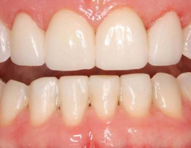 Veneers 4 after