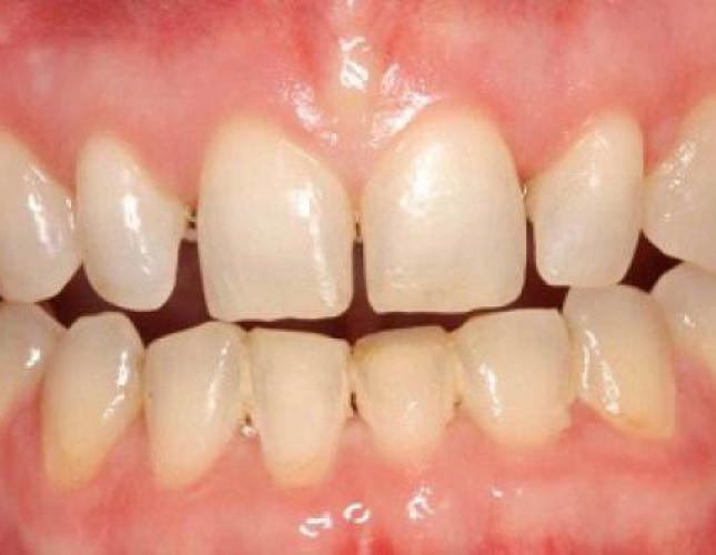 Veneers 4 before