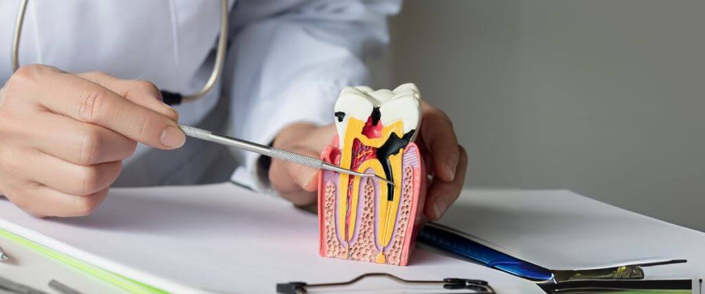 What to Expect During a Root Canal